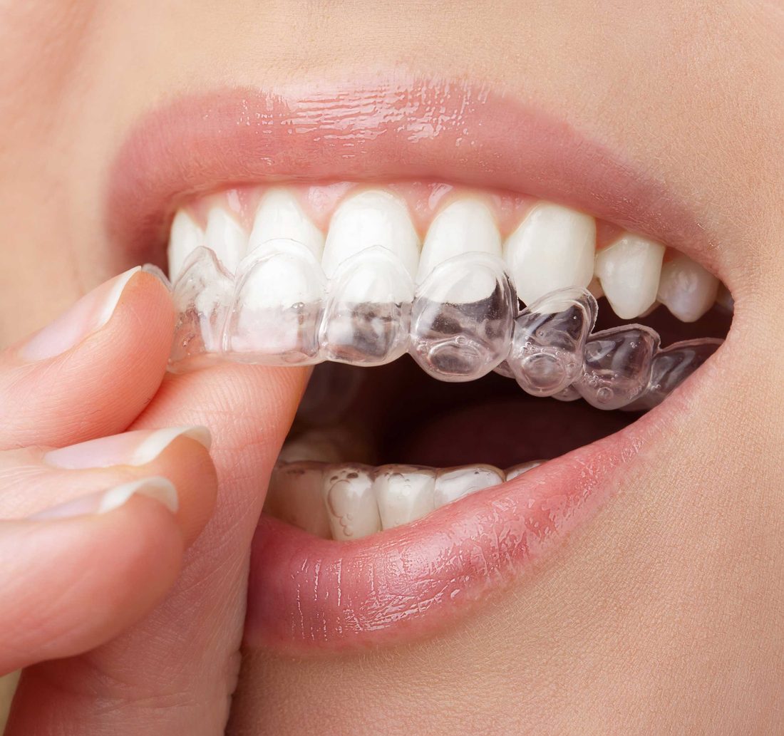 A clear orthodontic aligner being placed on the teeth.