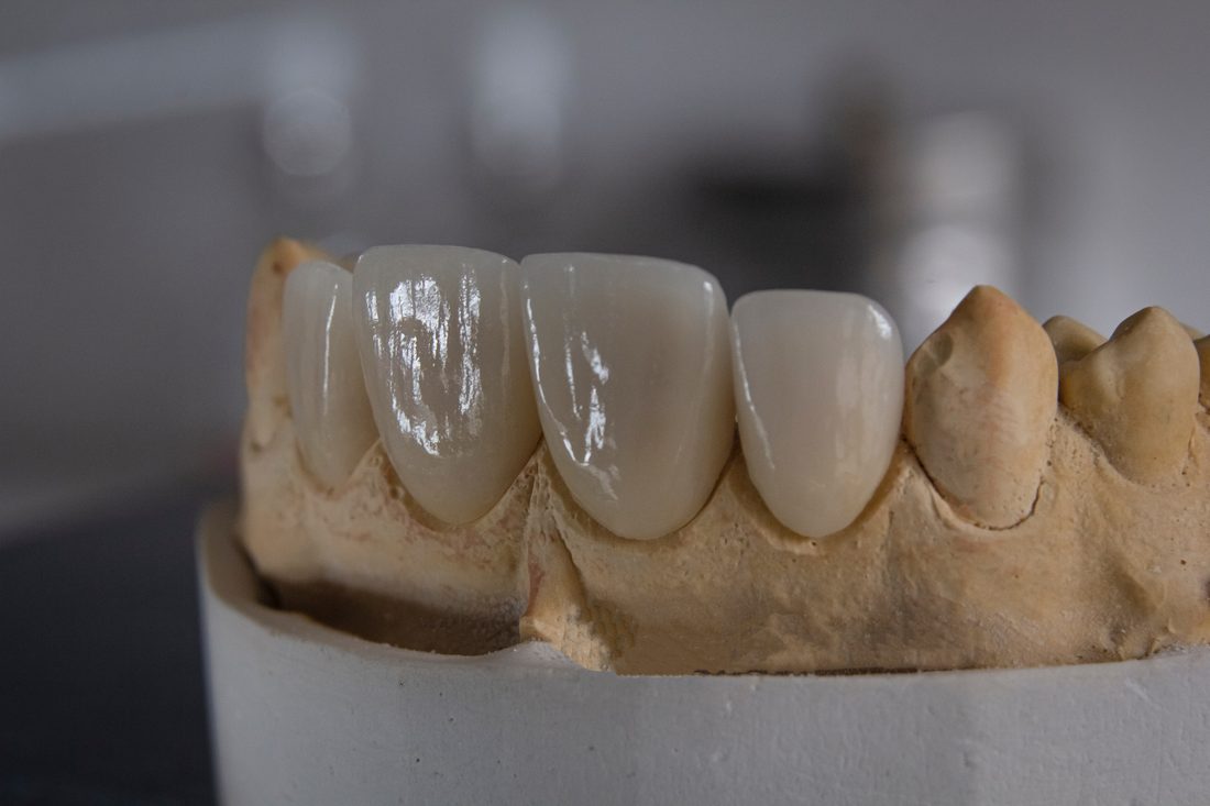 Zirconia and porcelain crowns on a working model.