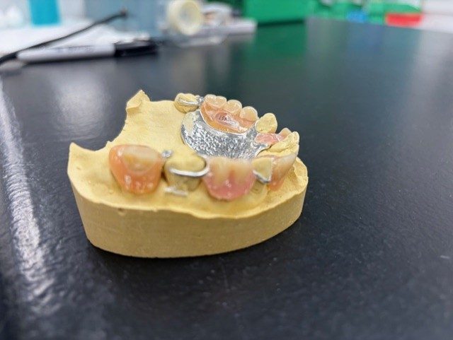 A cast-metal partial denture framework on a stone model.