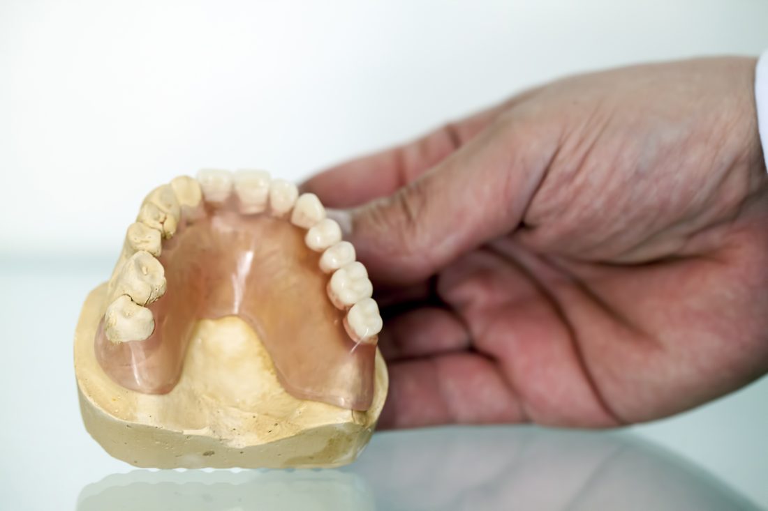A flexible partial denture on a stone model.